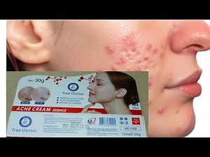 I Tried The Viral Doctor Tree Acne Remover Cream