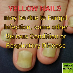 9.6K views · 44 reactions | FRIENDS, SEE WHAT SIGNS YOUR HAND NAILS SHOW ABOUT YOUR HEALTH, YOUR NAILS MAY GIVE YOU EARLY SIGNS & WARNING ABOUT SOME ILLNESS: | Indian Nuskhe | Facebook
