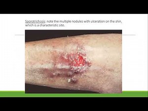 Lecture-139: S/C Mycosis: Sporotrichosis, Mycetoma, Chromo & Phaeohyphomycosis. Rook's chapter 32.