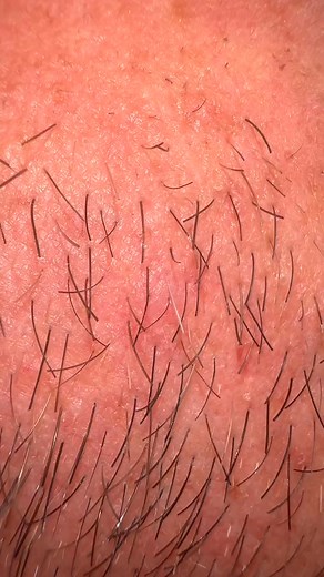 #sebaceousfilament #beardhairplucking #beard #multigemini #plucking #asmr | Jennifer M. Jane