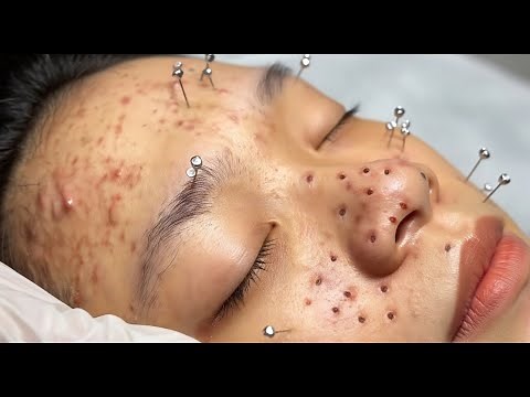 Loan Nguyen's ACNE Treatment Secrets Revealed