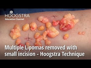 Multiple Lipomas removed with small incision - Hoogstra Technique - 23125