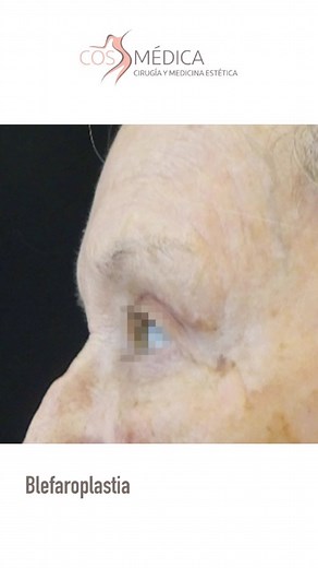 Blefaroplastia ✨👁️​ ✅ Eliminación de bolsas y ojeras, logrando una apariencia más descansada y juvenil. ​ ✅ Reducción de la piel sobrante en los párpados superiores e inferiores, para una mirada más abierta y fresca. ​ ✅ Resultados naturales y duraderos, con una recuperación rápida y mínimas cicatrices.​ ¿Quieres lucir unos ojos radiantes y revitalizados? ​ 📍Cosmédica Tenerife > ☎922 291 662 ​ 📍Cosmédica Gran Canaria > ☎928 074 221 ​ 📍Cosmédica Málaga > ☎952 073 600​ #Cosmédica #Blefaroplast