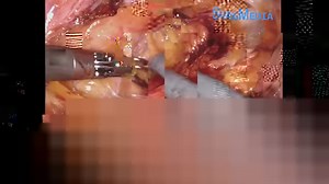 Robotic Sentinel Node Detection İn Endometrial Cancer using İndocyanine Green And Fluorescence İmaging. Sentinel lymph node mapping in endometrial cancer can help to provide the prognostic information needed while avoiding the morbidity associated with a complete lymphadenectomy. In this video Robotic Sentinel Lymph Node Biopsy plus Total Hysterectomy Bilateral Salpingo-Oophorectomy performed in patient with endometrial cancer. Credit: İsa Aykut Özdemir, MD/ Cihan Comba, MD/ Gökhan Demirayak, MD