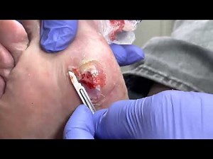 BIGGEST CALLUS EVER - Removing Hard Foot Callus #2 - Foot Care Podiatry