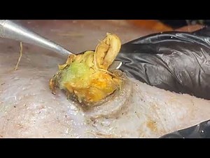 Join TLC Dr. Lee's Pimple Popper as they demonstrate the satisfying removal 1908M2hun 0186