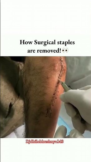 How surgical stapls are removed.?......!🙃#surgical #staples #video #medicaleducation