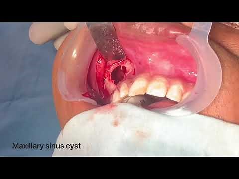 Large Maxillary Sinus Cyst Enucleated by Intra Oral Approach