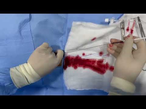 Digital Subtraction Angiography of Cerebral Vessels: Basic Technique