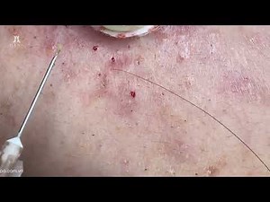 Big Cystic Acne Blackheads Extraction Blackheads & Milia, Whiteheads Removal Pimple Popping