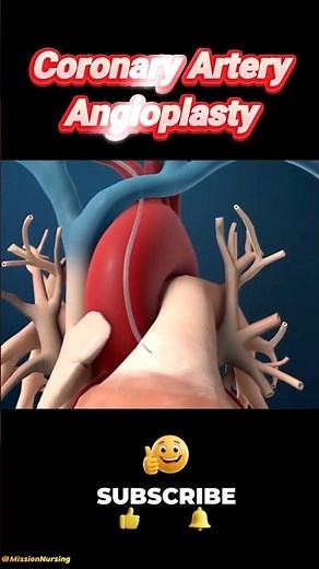 Coronary Artery Angioplasty surgical procedure #heartsurgery
