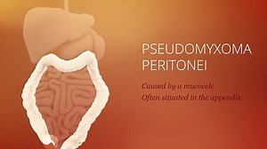 Mother, 35, has a two-in-a-million cancer