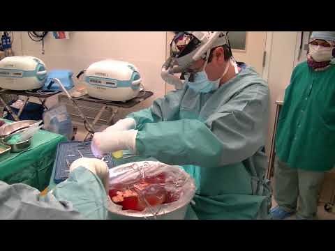 Groundbreaking Liver Surgery