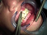Jaw Fracture - Fixating Mandible And Maxilla • Video • MEDtube.net