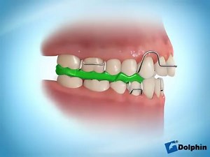 Twin Block Appliance | Dental Excellence