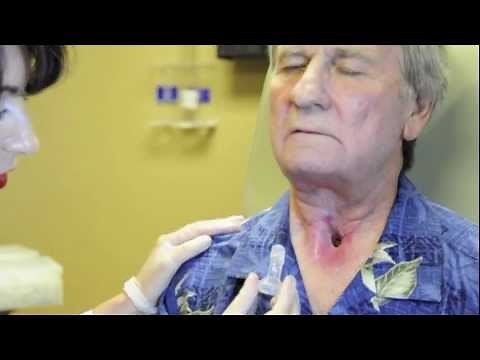 Placement of LaryTube (laryngectomy)