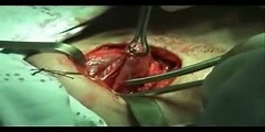 Thyroid Surgery and Thyroidectomy