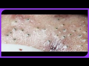 Satisfying Blackheads Removal Popping Pimples and Blackheads on Skin 2024