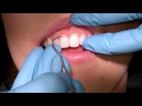 Anterior H6/7 Sickle Scaler