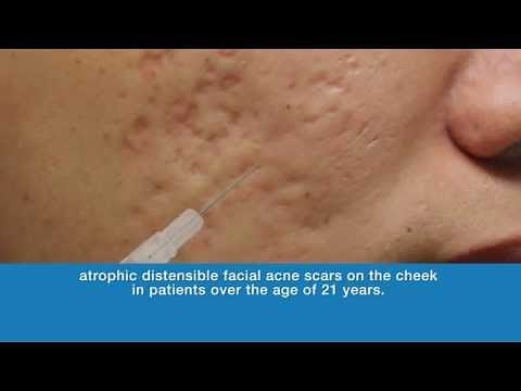 Bellafill® for Acne Scar Proposed Mechanism of Action