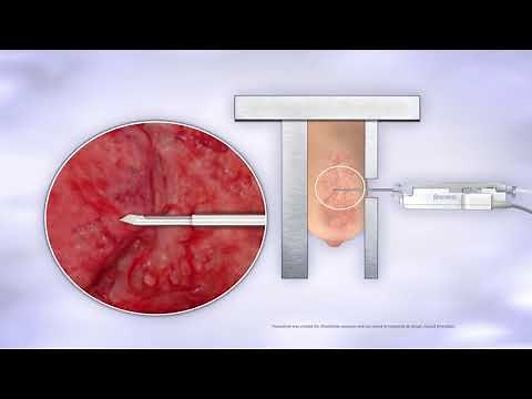 Brevera Breast Biopsy System - Animation