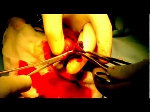 Adult Surgical old style Circumcision Dr.Kuber