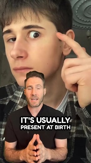 Marcus Gunn Jaw-Winking Syndrome (MGJWS) in adults is a rare congenital condition characterized by an abnormal connection between the facial and trigeminal nerves. This leads to a distinctive phenomenon where elevation of the eyelid occurs in conjunction with certain jaw movements, such as chewing or jaw opening. #oddities #stupidhumantricks #hiddentalent #medical #healthcare | Doctor Joe