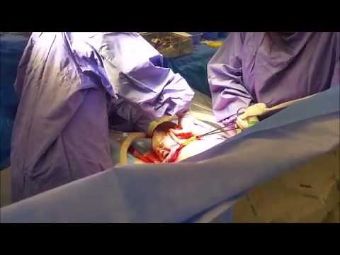 Newborn Baby C-Section Tiny Crying Loud & Angry!