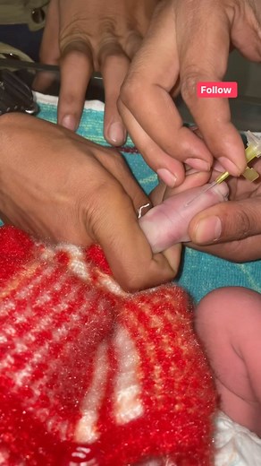 14K views · 55 reactions | Iv cannula technique in newborn #viral #trending #project | Barkat Choudhry | Facebook