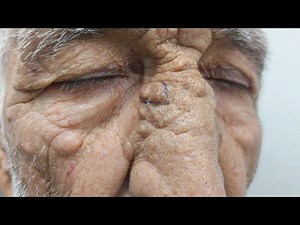 "Excision of Nasal epidermal cyst in an Elderly Patient with Favre-Racouchot Syndrome"