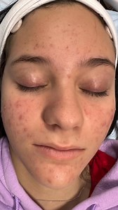 Look at the progress after just O N E #VIPeel by @__radiancebeauty 👀 Acne under control ✅ Brighter and more even skin ✅ Start your #chemicalpeeljourney TODAY by heading to the link in our bio to find a practitioner nearest you! | VI Peel