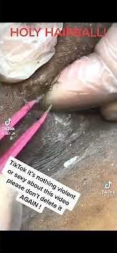 Holy Hairball! Ingrown Hair! #viralvideo #fyp #tiktok #youtube #viral #ingrownhair #pimple #cyst