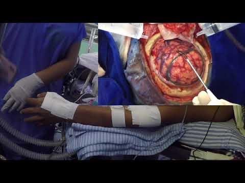 Awake craniotomy for right inferior lobule glioma