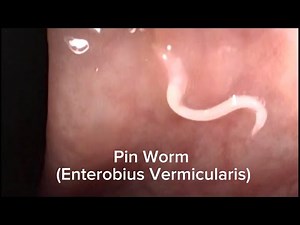 Colonoscopy showing Pin Worm (Enterobius Vermicularis)