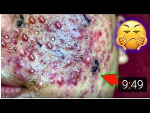 Blackheads & Milia, Big Cystic Acne Blackheads Extraction Whiteheads Removal Pimple Popping