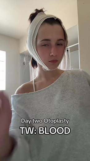 #surgery #ears #otoplasty #otoplastysurgery #earpinningsurgery #beforeandafter #otoplastyexplained | Willowt5
