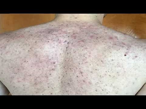 how to get rid of acne scars and redness on face DO THIS
