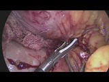 Laparoscopic Complete Mesocolic Excision (CME) and D3 Lymphadenectomy for Hepatic Flexure Tumor • Video • MEDtube.net