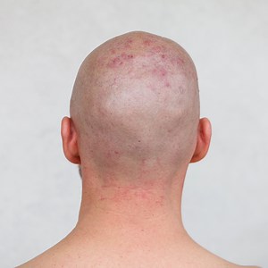 Scalp Acne: Causes, Prevention And remedy - Juicy Chemistry