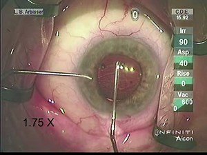 Dealing with Loose Zonules - Eyetube