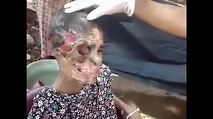 Victims Of Krokodil Drug