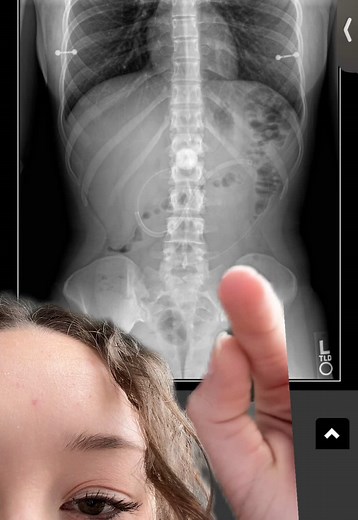 Understanding Kinked Feeding Tube Complications