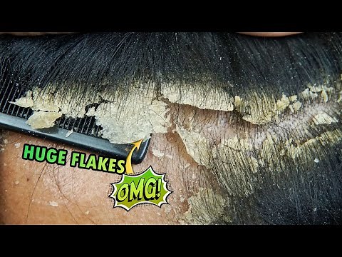Huge Dandruff Flakes Scratching Satisfying At Home #568