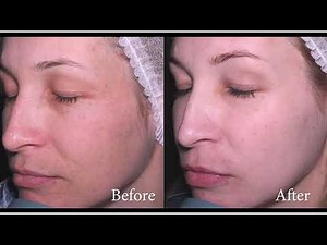 Brown Dermatology Phenol and Croton Oil Deep Chemical Peels