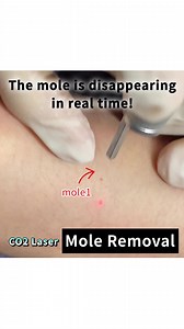 #mole removal treatment #lasertreatment #picolaser #picoway | Renewme Skin Clinic | Facebook