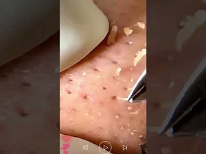 Skincare | Blackheads Removal #270 #tweezers skincare #blackheads blackheads