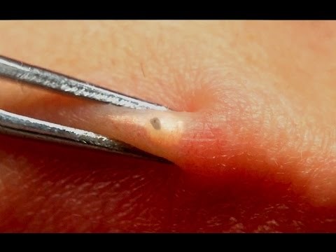 Lip Blackhead Removal