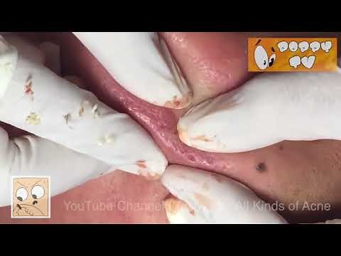 ❤️ Big Whiteheads Steatocystoma Multiplex Extraction ❤️