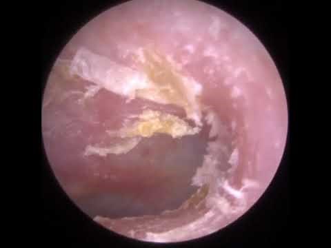 846 - Rock Solid Ear Wax Removal & Dead Skin Extraction