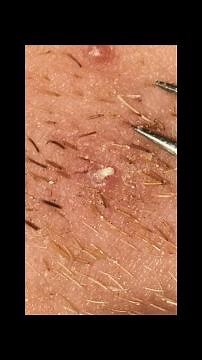A Strange Infected Ingrown Hair! Pili Multigemini?? Satisfying!